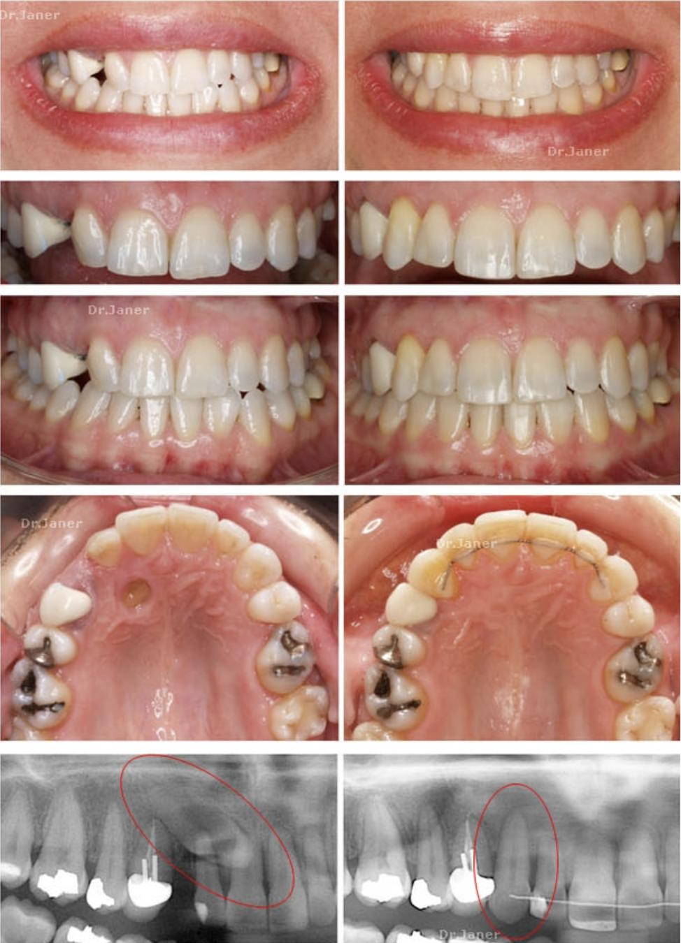 Invisalign Barcelona Con Canino En El Paladar Invisalign Barcelona