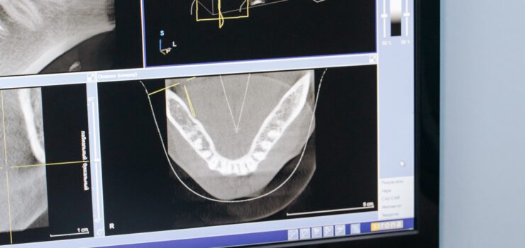 Invisalign Barcelona